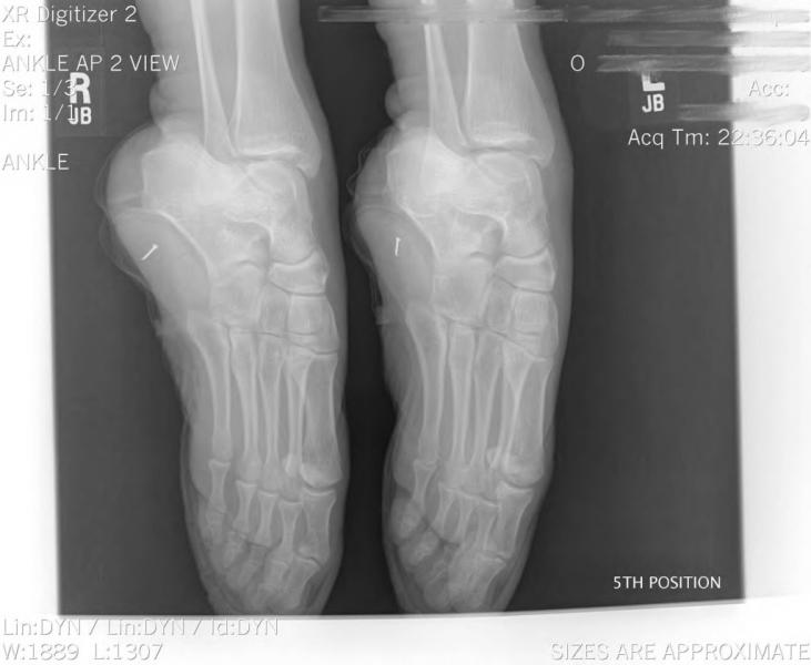 dance.net - x-ray of feet in pointe shoes (8799347) - Read article