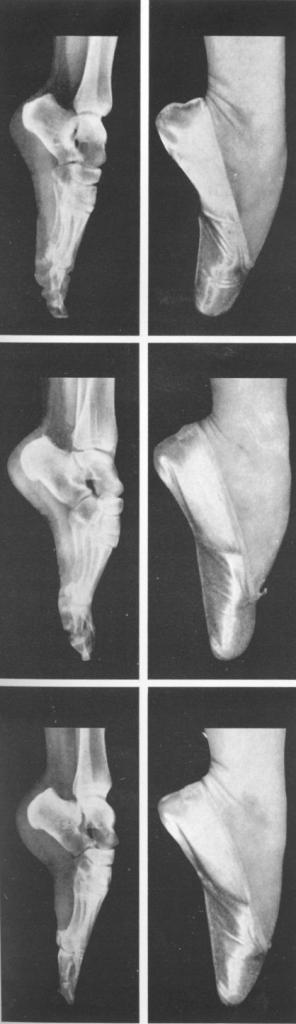 dance.net - Pointe X-rays, a bronze cast, and a darned pointe shoe