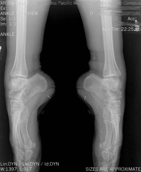 x-ray of feet in pointe shoes 